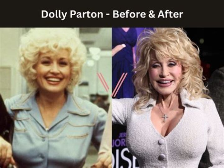 Are Dolly Parton's Iconic Breasts Real Or The Result Of Plastic Surgery?
