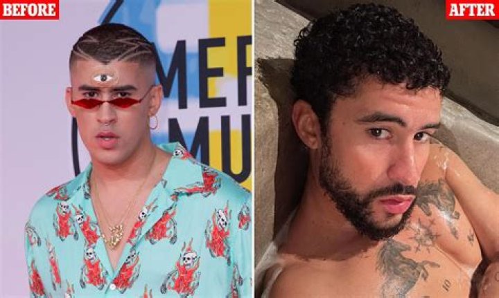 Bad Bunny Before Jaw Surgery: What Happened To His Jaw?