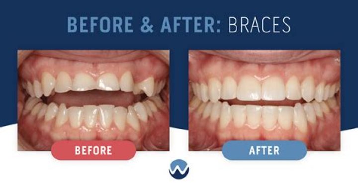 Has Barry Cast Used Braces And Whitening?
