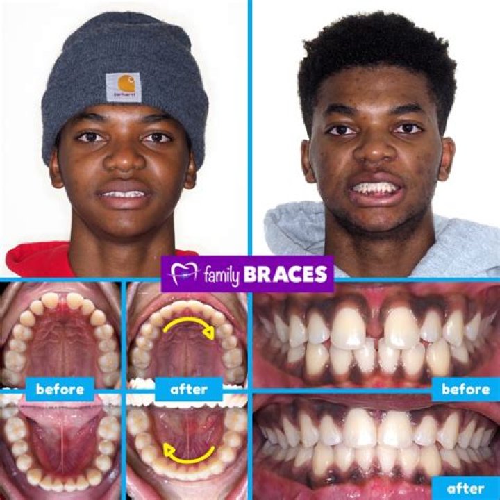 Mason Greenwood Teeth? Used Braces Or Fixed It