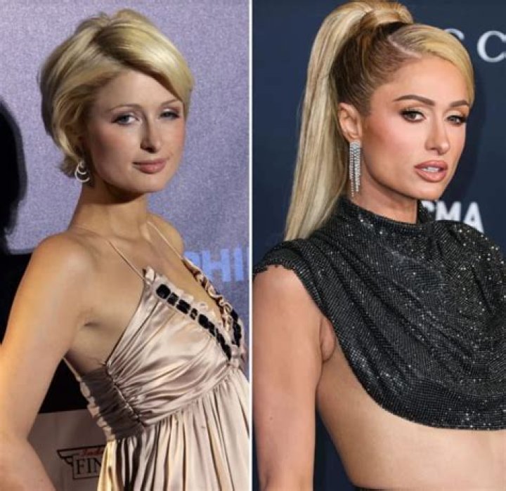 Paris Hilton's Surprising Plastic Surgery Journey: Before And After Photos
